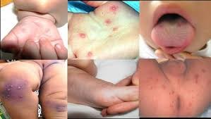 Triệu chứng và cách điều trị khi trẻ bị tay chân miệng
